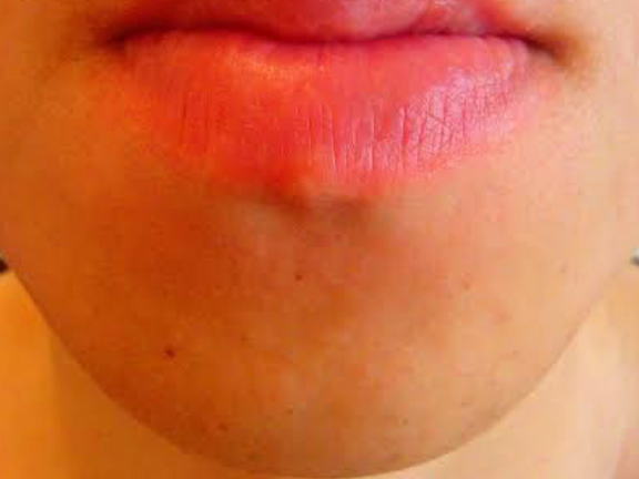 あごひげ脱毛後