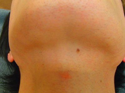 あごひげ裏脱毛After