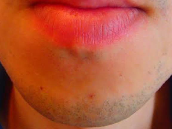 口下ひげ脱毛Before